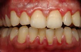 Pyorrhea Teeths